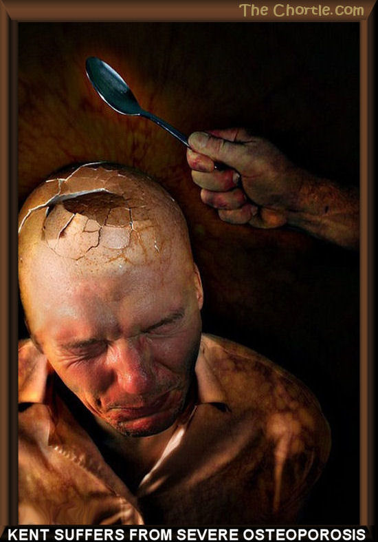 Kent suffers from severe osteoporosis